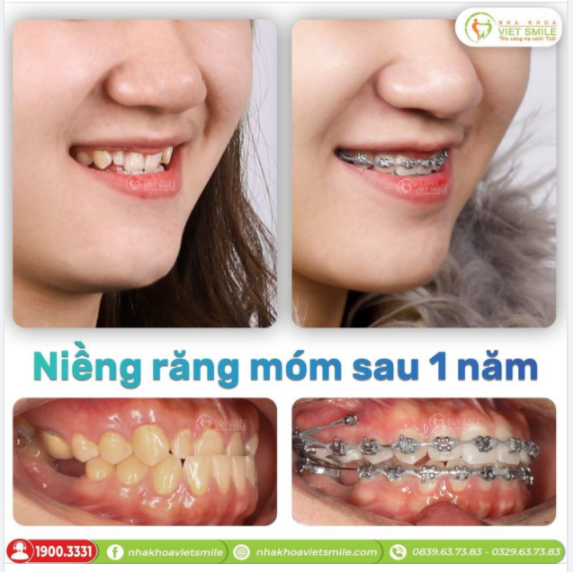 NIỀNG RĂNG MÓM, CẮN NGƯỢC SAU 1 NĂM