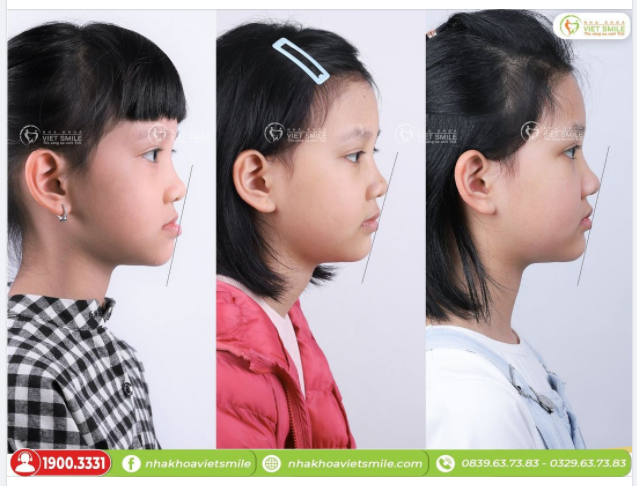 NIỀNG RĂNG MÓM TRẺ EM - GÓC NGHIÊNG ĐẸP HƠN