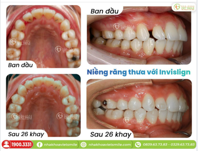 NIỀNG RĂNG THƯA VỚI INVISALIGN LÀ QUYẾT ĐỊNH ĐÚNG ĐẮN