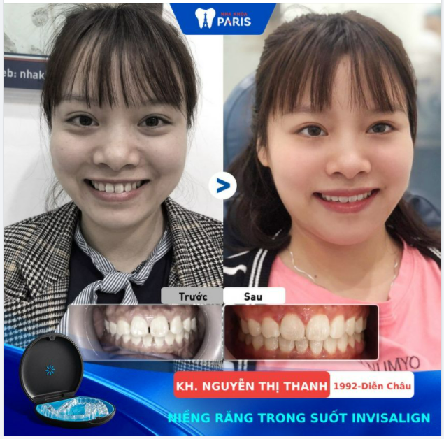 NIỀNG RĂNG TRONG SUỐT - THUẬN CHO TRẢI NGHIỆM, LỢI CHO SỰ NGHIỆP