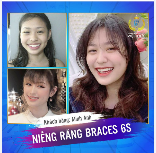 “Niềng răng xong chẳng còn gì, mấy chiếc răng thò thụt lúc trước biến mất rồi, chỉ còn lại nụ cười xinh đẹp thế này đây . Thêm động lực cho các bạn niềng răng nhé ​​​​​​​”