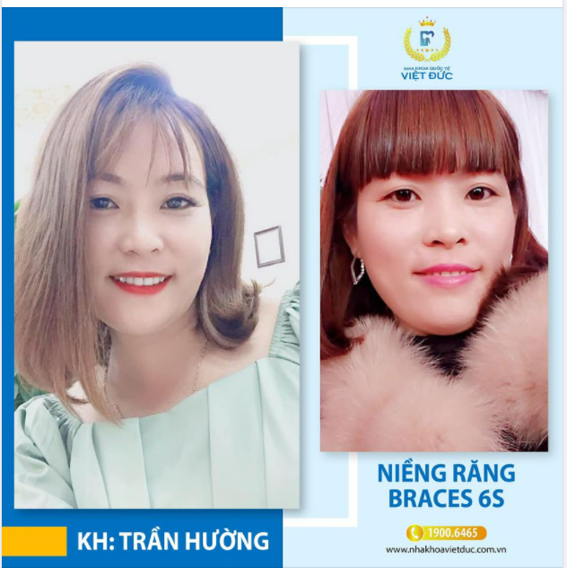 NIỀNG RĂNG XONG TRẺ RA CHỤC TUỔI