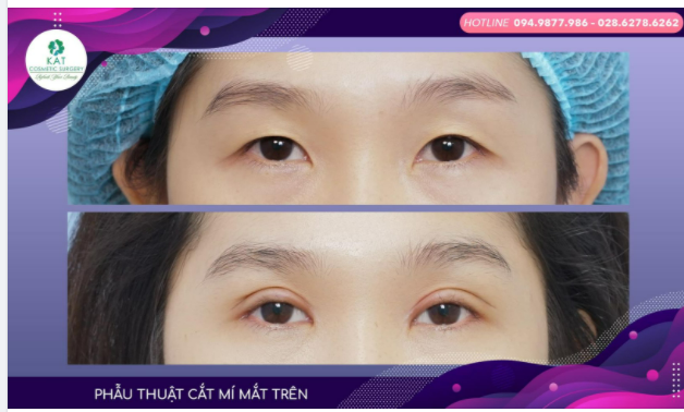 Phẫu thuật cắt mí mắt trên tại KAT đã giúp bạn tạm biệt đôi mắt buồn, không nếp mí và trao lại cho bạn một đôi mắt thật tròn xinh .