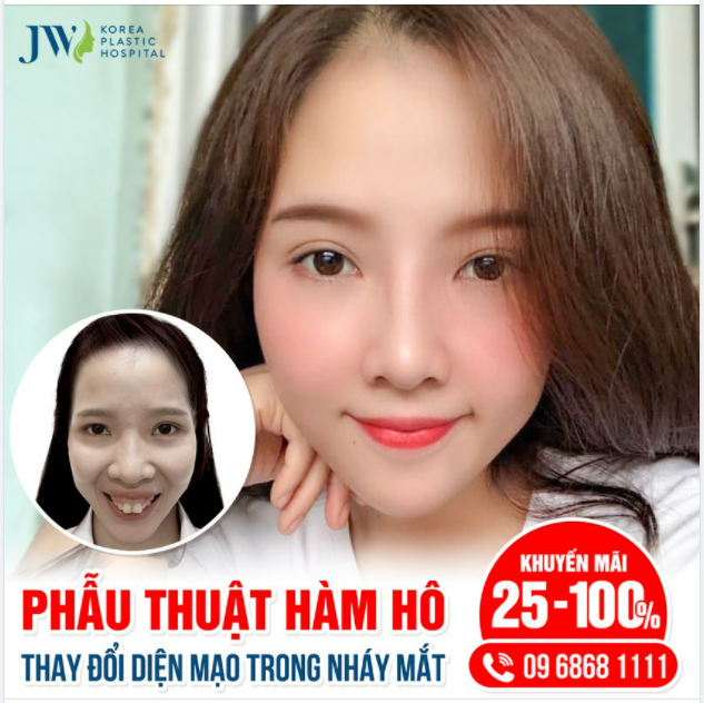 PHẪU THUẬT HÀM HÔ THAY ĐỔI DIỆN MẠO TRONG NHÁY MẮT