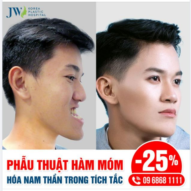 PHẪU THUẬT HÀM MÓM GIẢI PHÁP “LỘT XÁC” HOÀN TOÀN