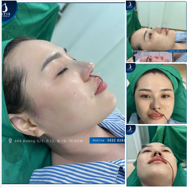 Phorm mũi dáng tự nhiên mũi bán cấu trúc.
