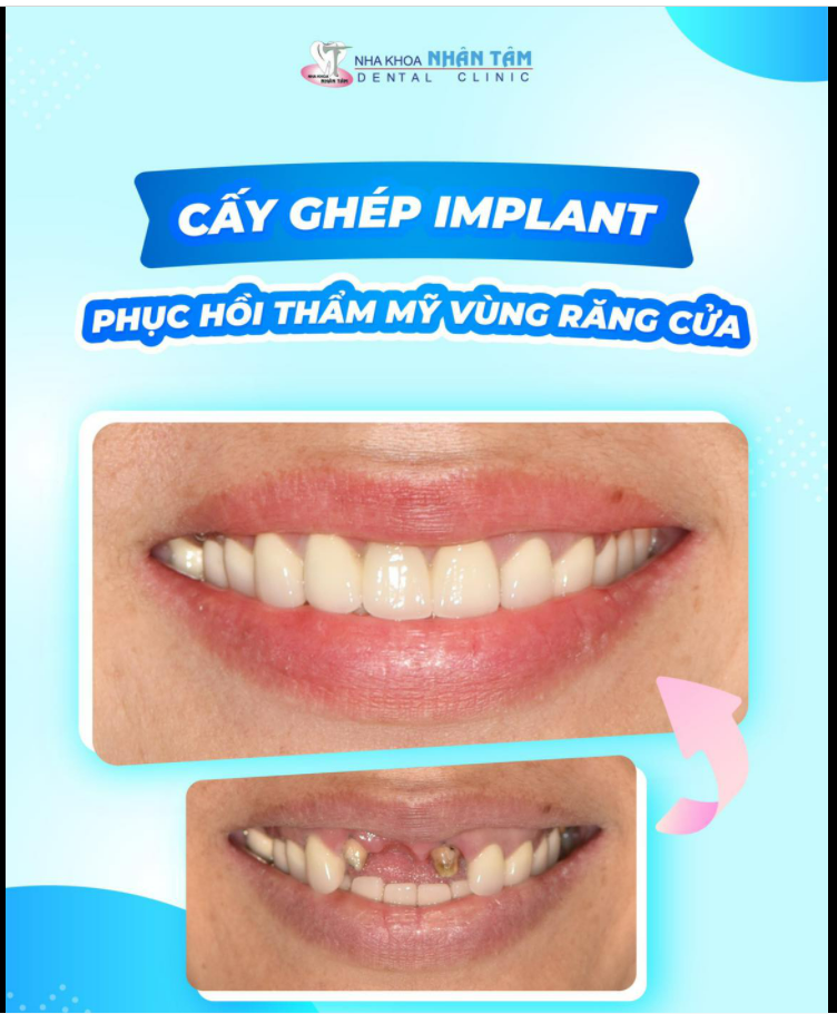Phục hồi răng cửa khác gì so với phục hồi răng ở những vùng khác