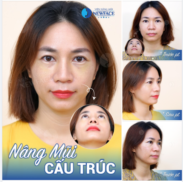 Ps Cô ấy chọn cách đầu tư cho bản thân là nâng mũi cấu trúc.