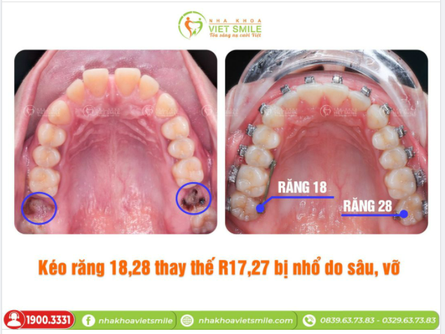 RĂNG 8 (RĂNG KHÔN) CÓ THỰC SỰ MỌC NGU