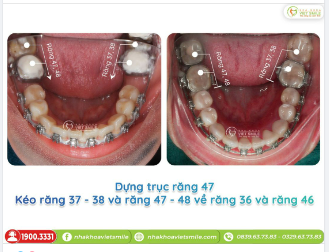 RĂNG 8 (RĂNG KHÔN) CÓ THỰC SỰ MỌC NGU