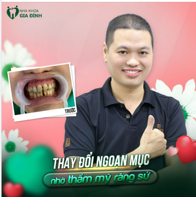 RĂNG BẠN CÓ ĐANG GẶP TÌNH TRẠNG Ố VÁNG, THƯA, HÌNH THỂ XẤU, MÒN CỔ CHÂN RĂNG