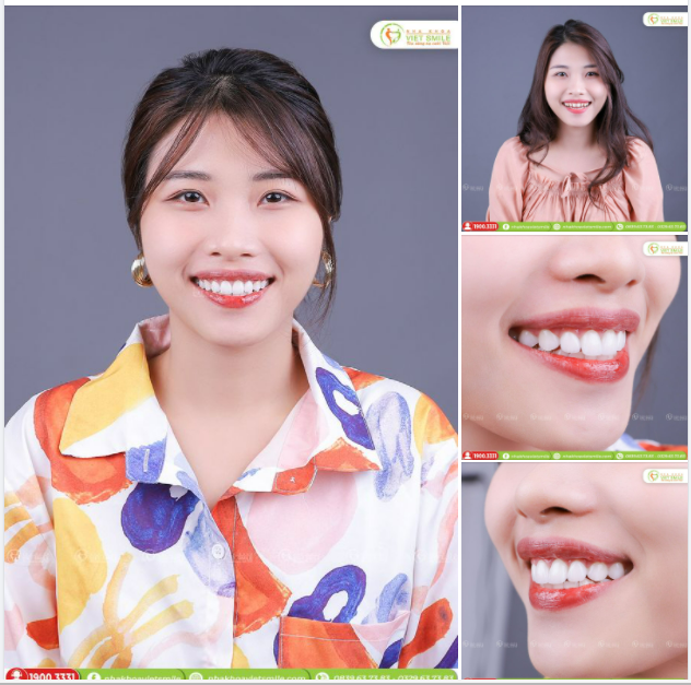 RĂNG ĐỀU ĐẸP, HẾT KHE THƯA CÙNG RĂNG SỨ THẨM MỸ