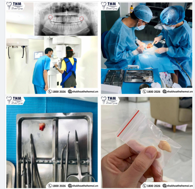Răng Khôn Khó Chịu, Có Bác Sĩ Chuyên Môn Lo