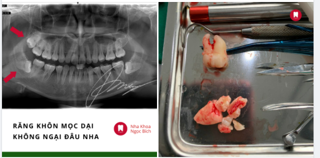 RĂNG KHÔN MỌC DẠI - KHÔNG NGẠI ĐÂU NHA
