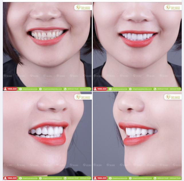 RĂNG KHÔNG ĐỀU CÓ DÁN SỨ VENEER ĐƯỢC KHÔNG