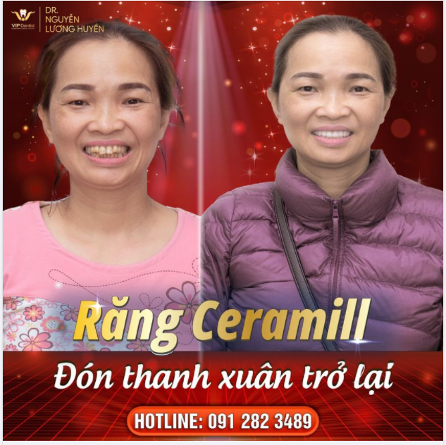 RĂNG SỨ CERAMILL - ĐÓN THANH XUÂN TRỞ LẠI