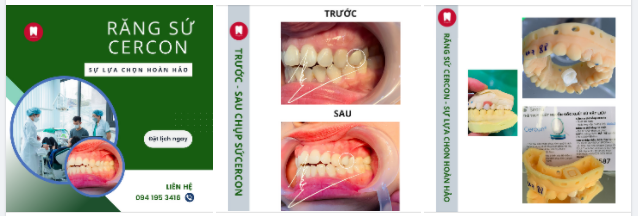RĂNG SỨ CERCON - SỰ LỰA CHON HOÀN HẢO