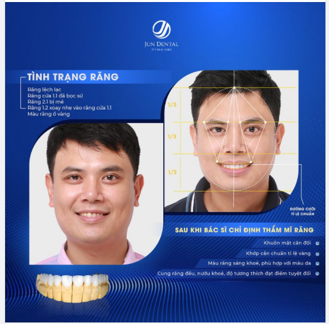 RĂNG SỨ DMAX - RĂNG SỨ NAM TÍNH MỘT CÁCH TỰ NHIÊN