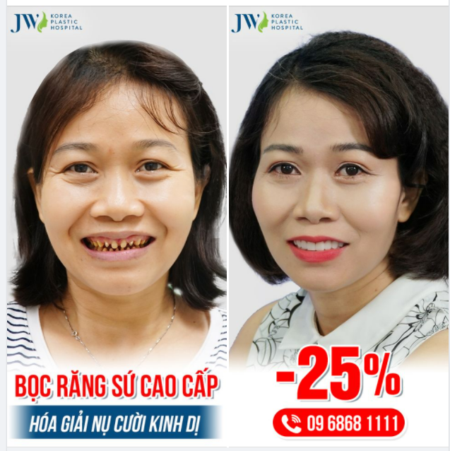 RĂNG XẤU TỰ TI LẮM, BỌC RĂNG SỨ ĐI