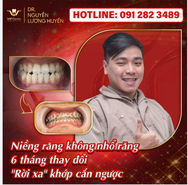 RỜI XA KHỚP CẮN NGƯỢCMÓM - THAY ĐỔI CHỈ SAU 6 THÁNG NIỀNG RĂNG KHÔNG NHỔ RĂNG