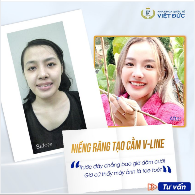 SAI KHỚP CẮN NẶNG, LỆCH HÀM - ĐI KHÁM ĐÂU CŨNG BẢO PHẢI PHẪU THUẬT HÀM