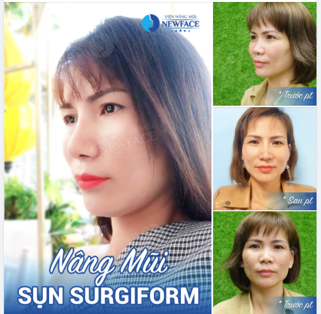 “SANG XỊN MỊN” HƠN HẲN NHỜ NÂNG MŨI ĐẶT SỐNG