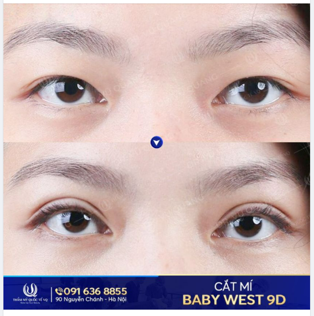 Sao phải dành cả thanh xuân để kích mí