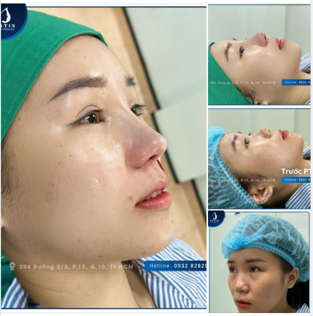 Sau khi tìm hiểu kỹ càng thì chị khách hàng đã chốt hạ được một chiếc mũi xinh xắn