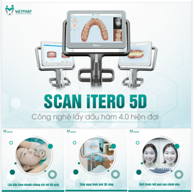 SCAN ITERO 5D - ỨNG DỤNG CÔNG NGHỆ 4.0 TRONG CHỈNH NHA INVISALIGN TẠI VIỆT PHÁP