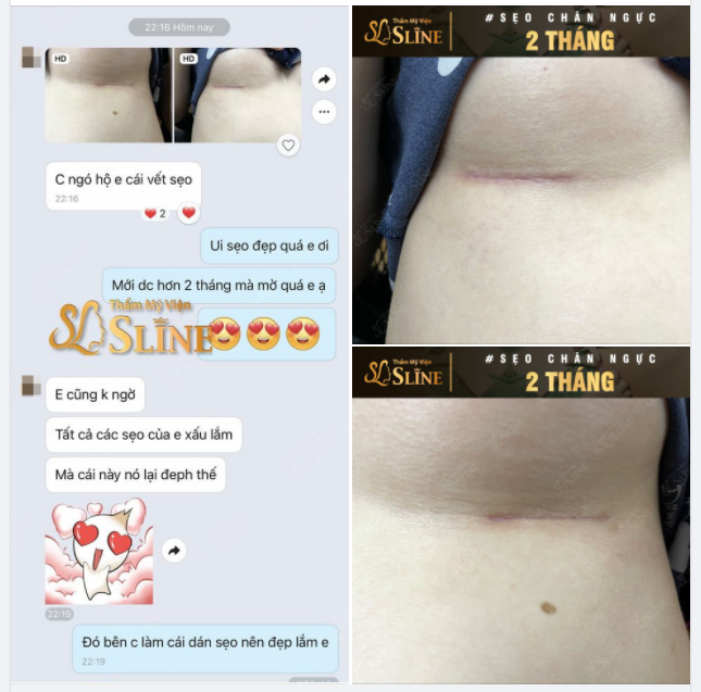 SẸO ĐẶT TÚI NGỰC sau 2 tháng.