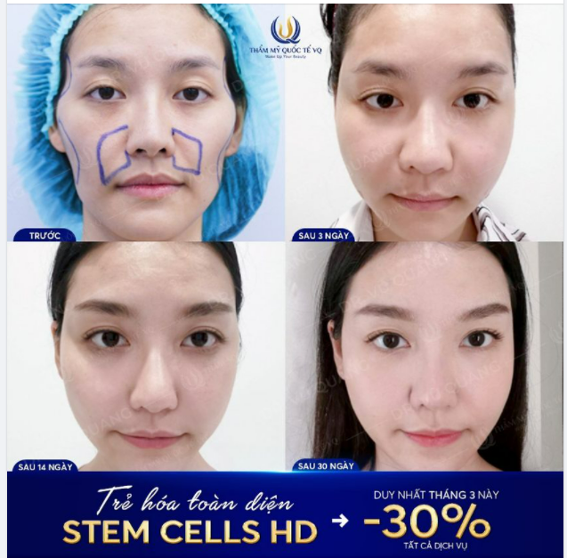 Siêu trẻ toàn diện Stem Cells HD - Giữ gìn sắc xuân