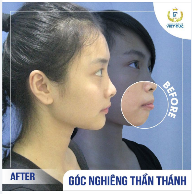 SỞ HỮU GÓC NGHIÊNG THẦN THÁNH NHỜ NIỀNG RĂNG V-LINE