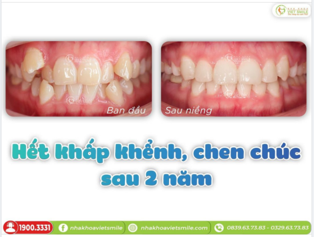 SỞ HỮU NỤ CƯỜI KhOẺ ĐẸP SAU 2 NĂM NIỀNG RĂNG KHẤP KHỂNH