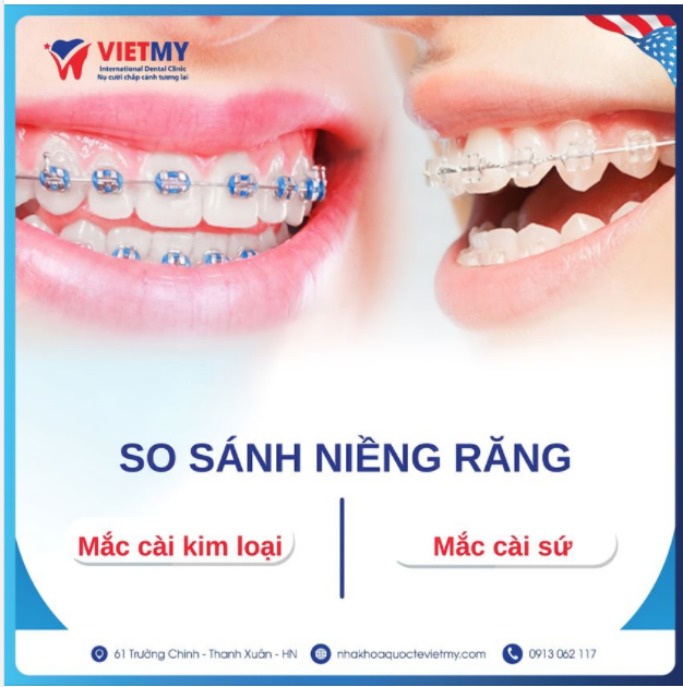 SO SÁNH NIỀNG RĂNG MẮC CÀI KIM LOẠI VÀ MẮC CÀI SỨ