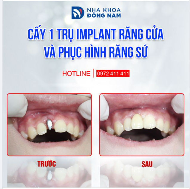 SỰ ĐẢM BẢO CỦA NHA KHOA ĐÔNG NAM XỨNG ĐÁNG ĐỂ TÔI TIN TƯỞNG TRỒNG RĂNG IMPLANT
