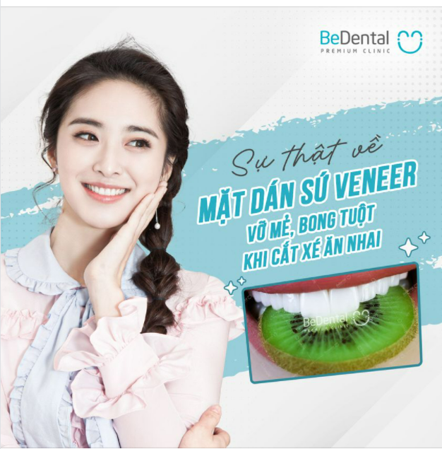 Sự thật về mặt dán sứ Veneer bị vỡ mẻ, bong tuột khi cắn xé ăn nhai