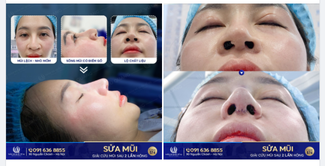 Sửa lại mũi hỏng - Có dễ dàng như bạn nghĩ