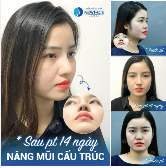 TÁI CẤU TRÚC MỘT CHIẾC MŨI BIẾN CHỨNG