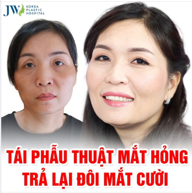 TÁI PHẪU THUẬT MẮT - PHÉP MÀU CỦA NHỮNG ĐÔI MẮT HƯ