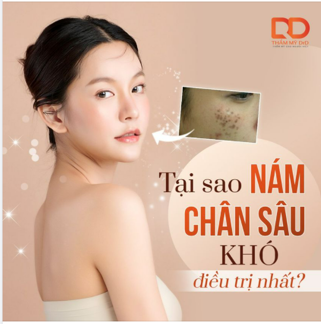 Tại sao nám chân sâu khó điều trị nhất