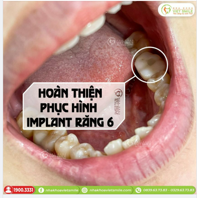 TẠI SAO NÊN TRỒNG RĂNG IMPLANT - PHỤC HÌNH RĂNG SỐ 6 SỚM