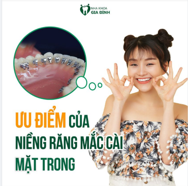 TẠI SAO NIỀNG RĂNG MẮC CÀI MẶT TRONG CHI PHÍ LẠI CAO HƠN MẮC CÀI THƯỜNG