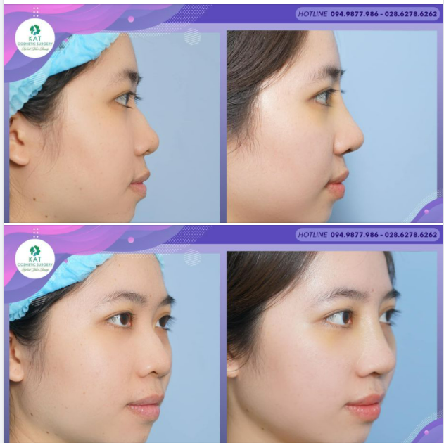 “Tạm biệt chiếc mũi gồ ghề khiến bạn không tự tin”