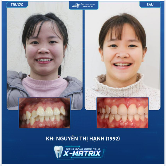 TẠM BIỆT RĂNG HÔ, KHẤP KHỂNH NHỜ CÔNG NGHỆ NIỀNG RĂNG X-MATRIX