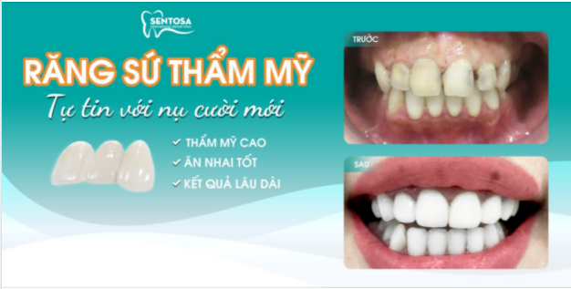 TẠM BIỆT RĂNG XỈN MÀU, RĂNG THƯA VỚI 2 BUỔI HẸN
