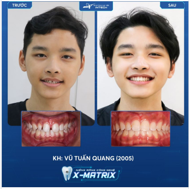 TÂN TRANG NỤ CƯỜI NHỜ NIỀNG RĂNG CÔNG NGHỆ X-MATRIX