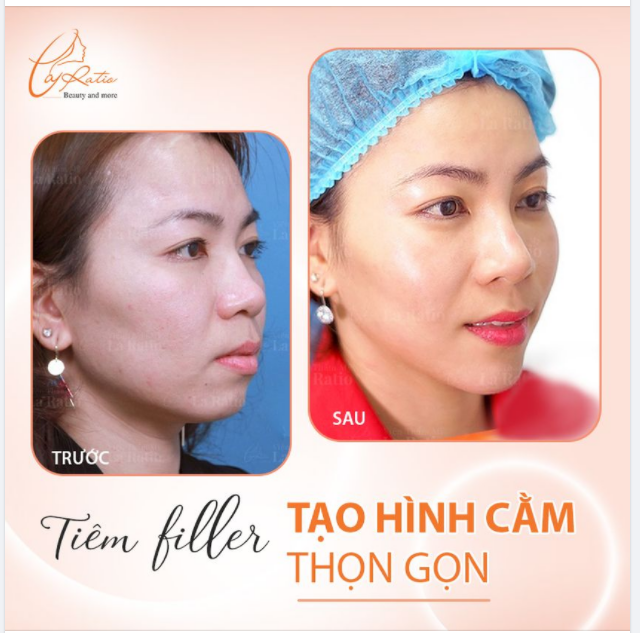 TẠO CẰM V-LINE KHÔNG PHẪU THUẬT
