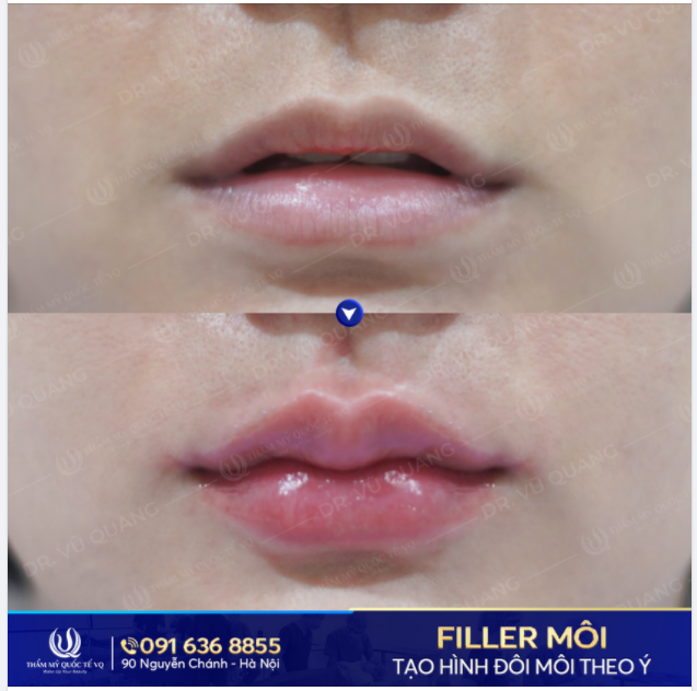 Tạo hình đôi môi căng mọng bằng filler Đẹp tự nhiên - mềm mại - an toàn