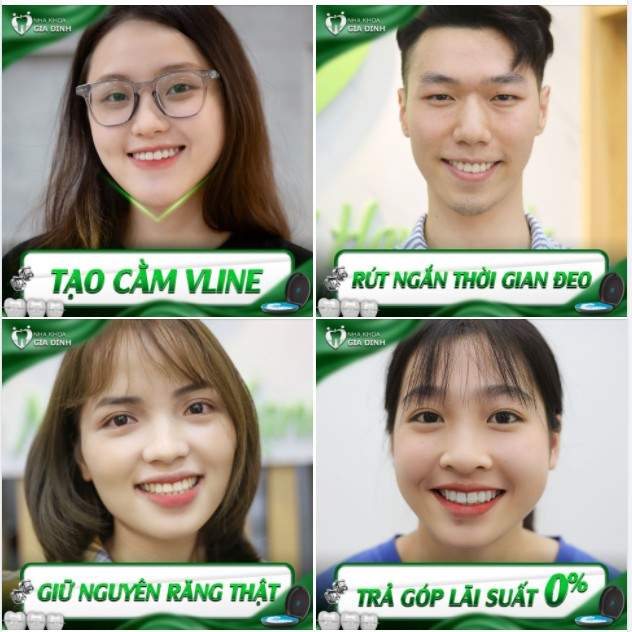 THÀNH HOTGIRL HOTBOY SAU KHI NIỀNG RĂNG CHỈNH NHA