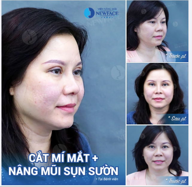 THÀNH PHIÊN BẢN HOÀN HẢO HƠN SAU COMBO MÍ + MŨI